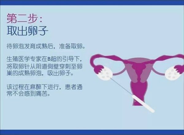 试管婴儿技术_格鲁吉亚试管婴儿费用_辅助生殖技术流程