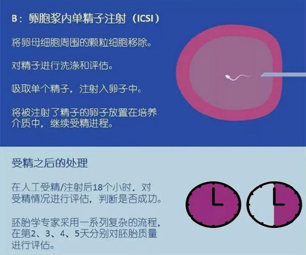 格鲁吉亚试管婴儿费用_试管婴儿技术_辅助生殖技术流程