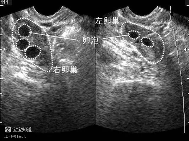 试管婴儿适应症_格鲁吉亚助孕流程_输卵管堵塞做试管婴儿